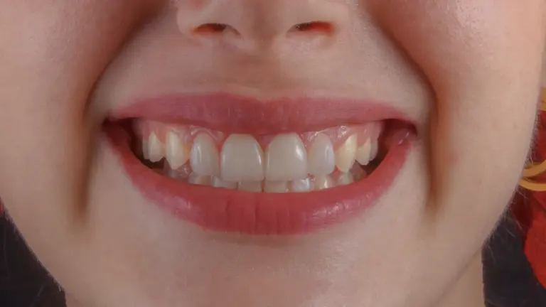 Dreaming About Teeth Falling Out: Meaning, Stress, and Physical Cues